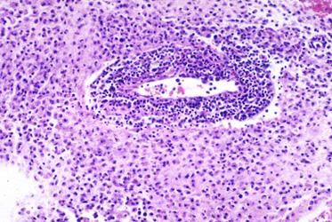 HSV encephalitis biopsy